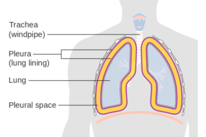 What Are Lung And Pleural Biopsies?